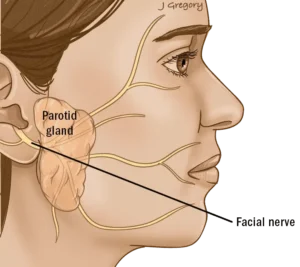 Parotidectomy