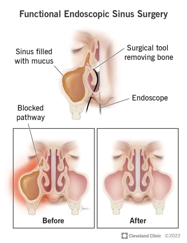 Functional Endoscopic Sinus Surgery (FESS)