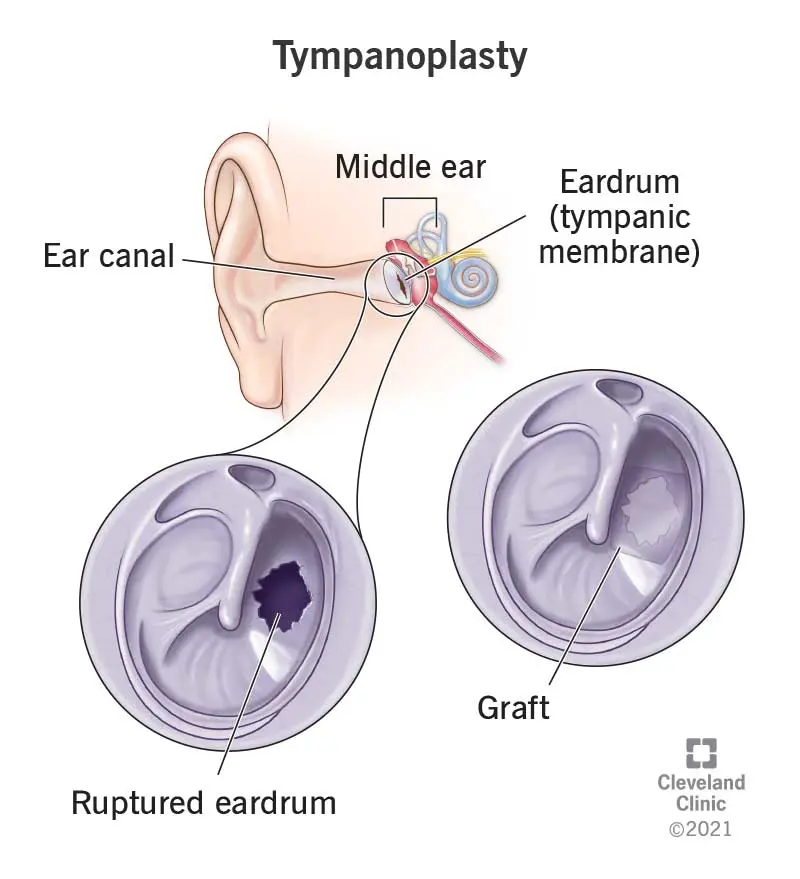 Tympanoplasty