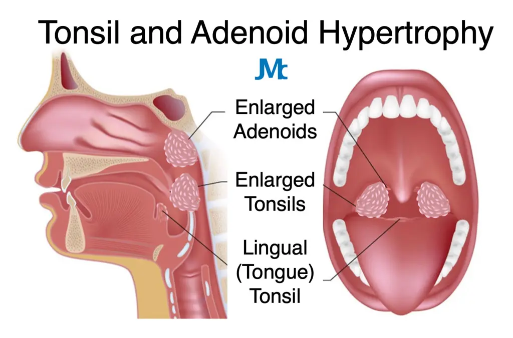 Adenoidectomy