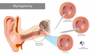 Myringotomy