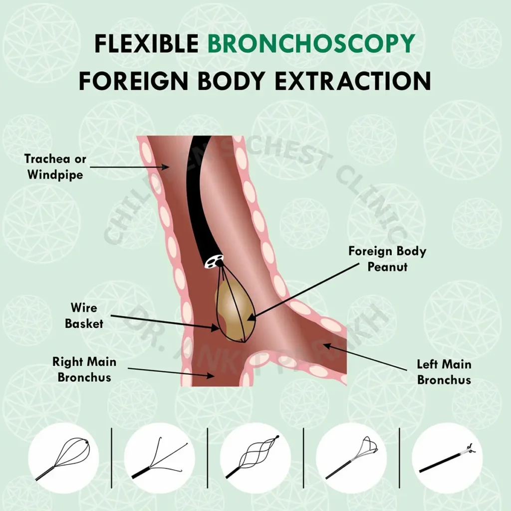 Bronchoscopy and Foreign Body Extraction