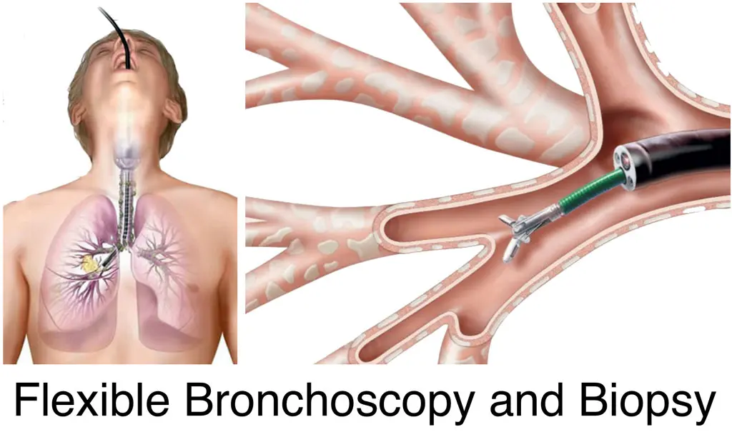 Flexible Bronchoscopy and Biopsy