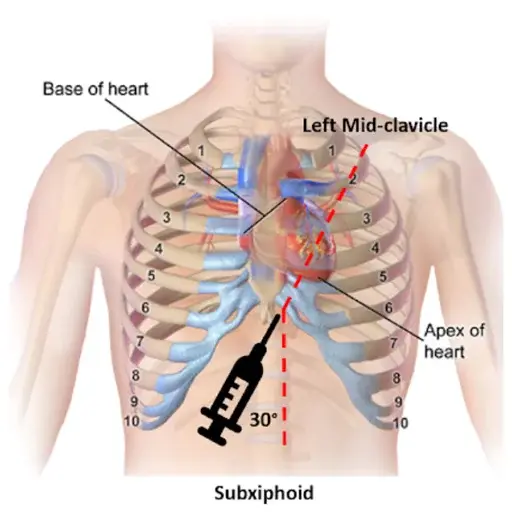 Pericardial Effusion Drainage