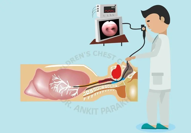 Flexible Bronchoscopy