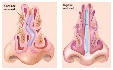 Submucous Resection