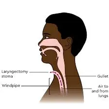 Laryngectomy