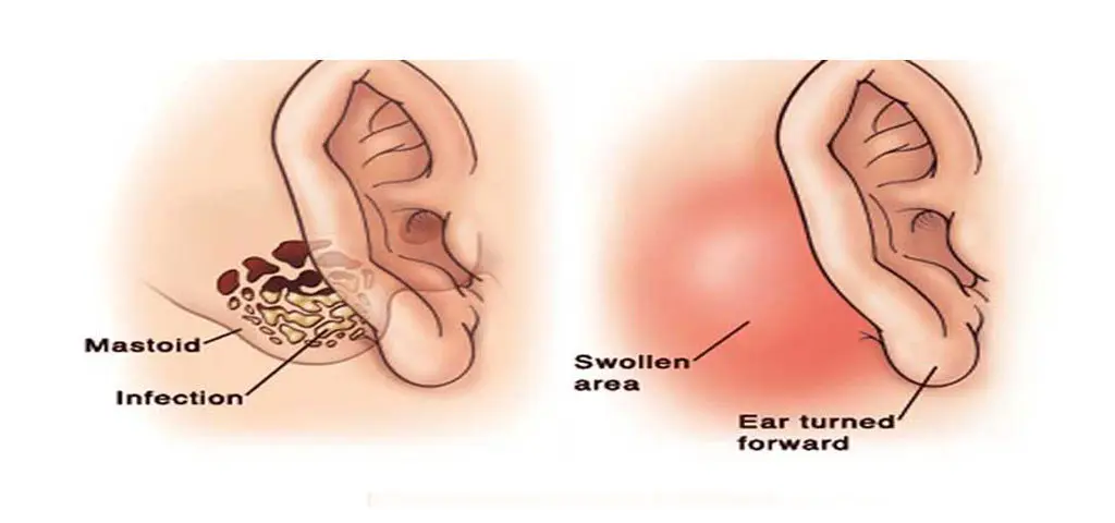 Mastoidectomy