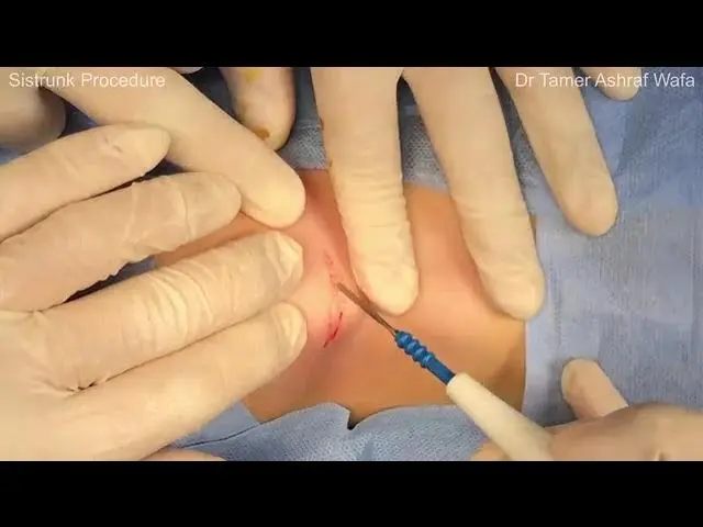 SIS-Trunk Excision