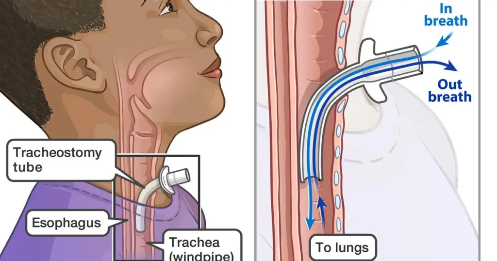 Tracheostomy